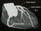 CORONARY CT CALCIUM SCORE