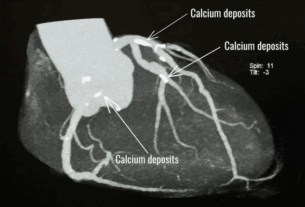 CORONARY CT CALCIUM SCORE