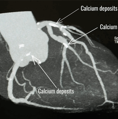 CORONARY CT CALCIUM SCORE