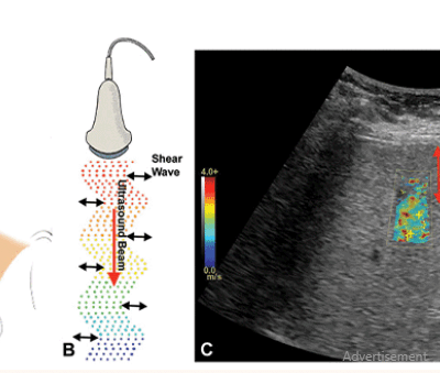 FIBROSCAN
