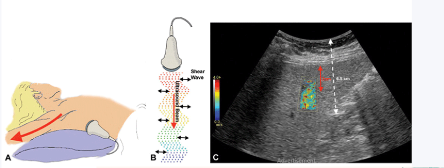 FIBROSCAN