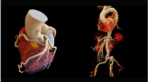 cardiac ct